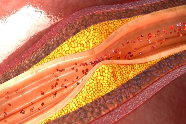 New research shows that statins slow the progression of atherosclerosis in coronary arteries.