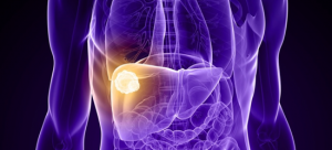 Ray of hope: Radiotherapy improves survival of patients with liver cancer invading the portal vein