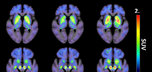 The tracer 18F-AV-1451 may help diagnose progressive supranuclear palsy